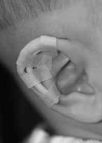 splint taped ear