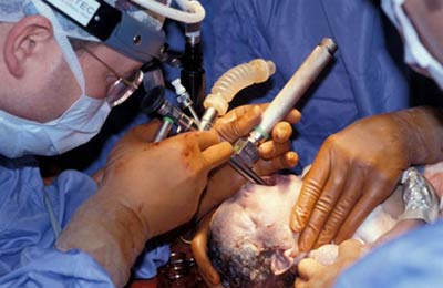 Bronchoscopy during an EXIT procedure to secure a fetal airway.