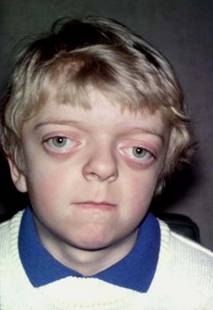 Child with Crouzon syndrome prior to correction.