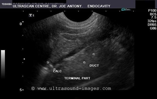 http://www.ultrasound-images.com/admin/uploads/wharton-duct-calc-2d.jpg